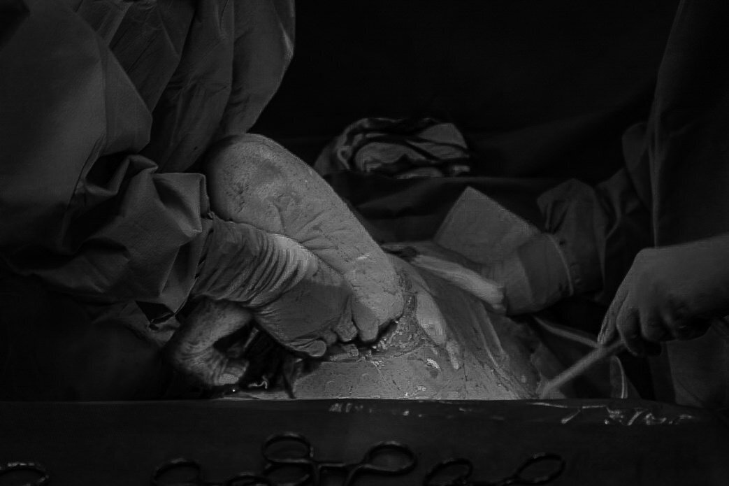 Geboortefotografie tijdens een keizersnede