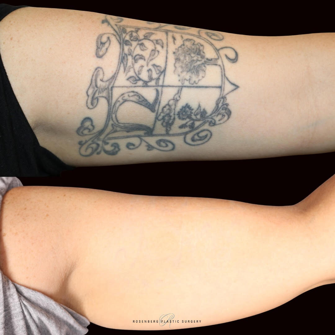 Tattoo Removal Results