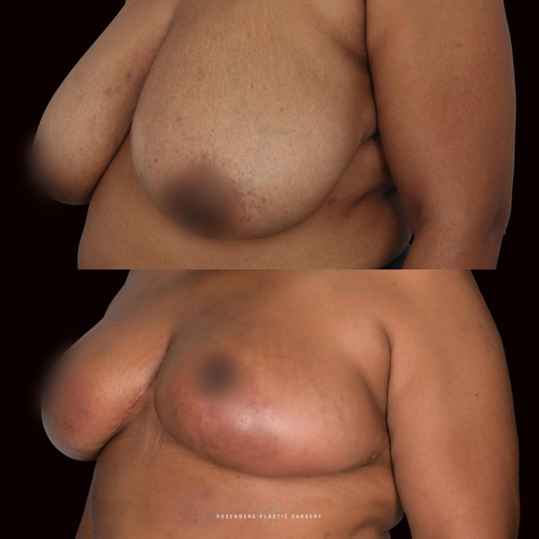 Breast Reduction and Lift Results