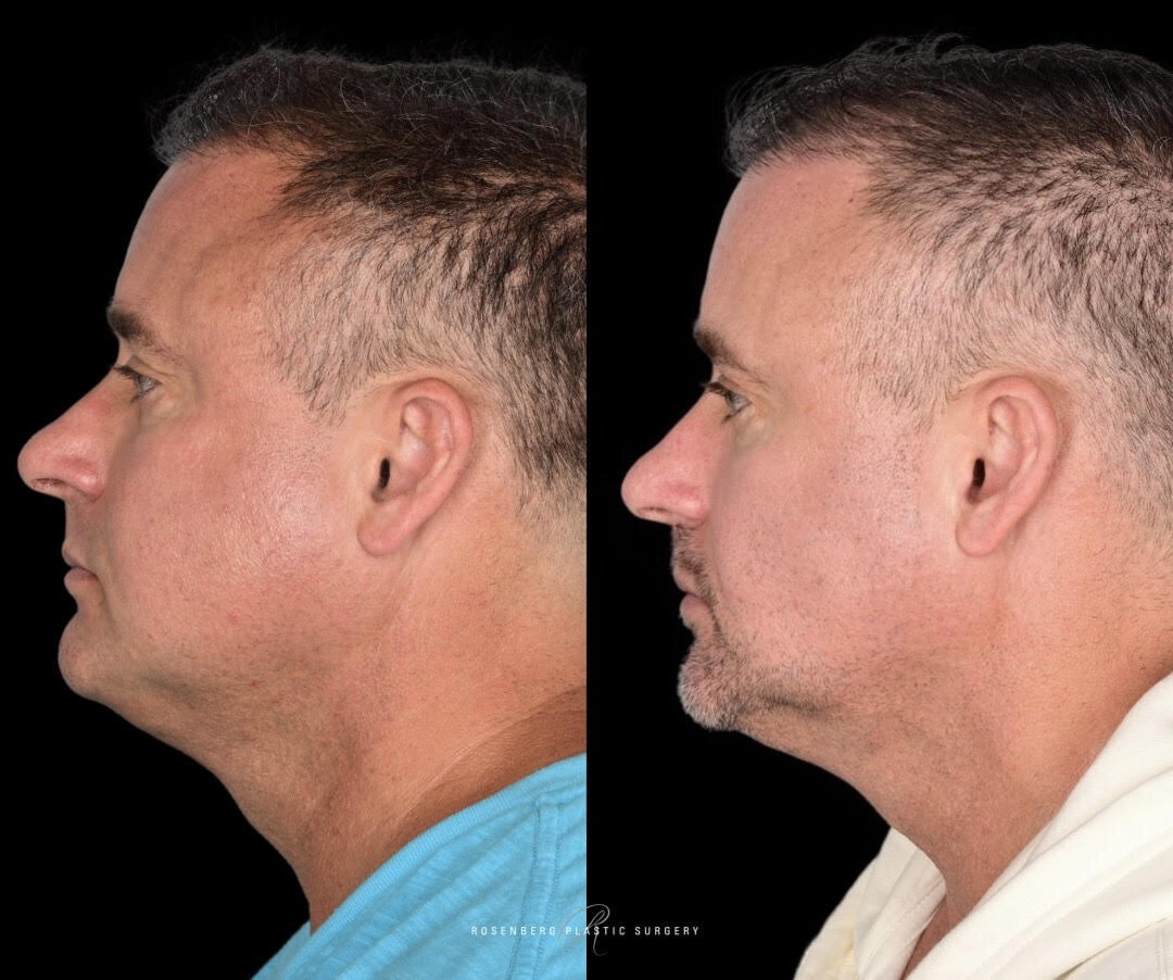 Buccal Fat Pad Results