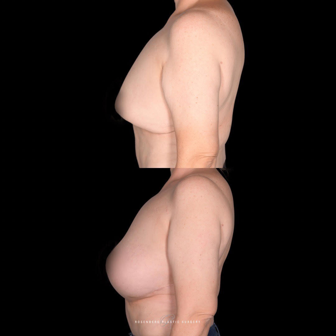 Breast Augmentation Results