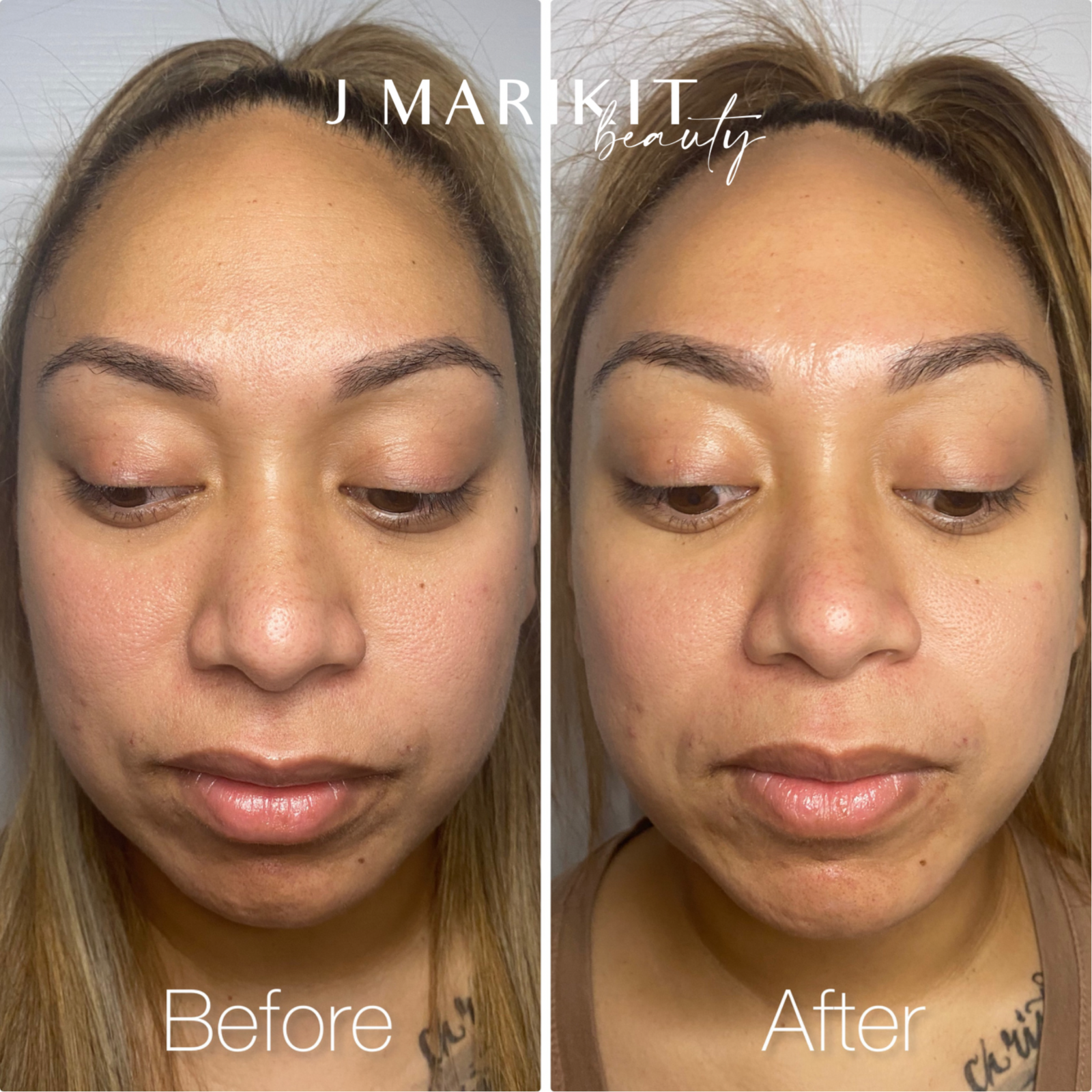 Honolulu skin exfoliation treatment provided by JMarkit .