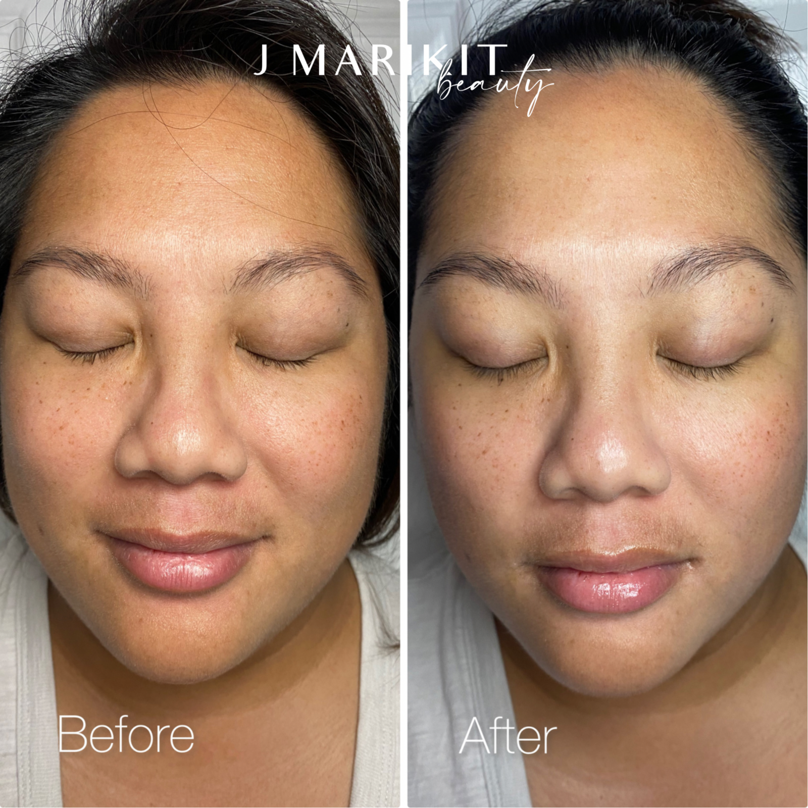 Oahu chemical peel before and after images.