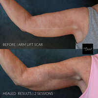 arm-lift-scar-camouflage-2 (1)