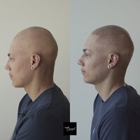 Alex-alopecia-copy-2