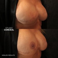 medical nipple tattoo2