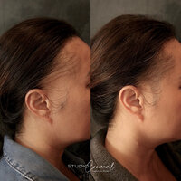 alopecia-hair-tattoo-arizona