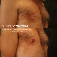 male breast cancer areola tattoo
