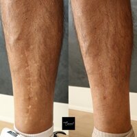 flat-foot-surgical-scar-cover-up-2-2-1