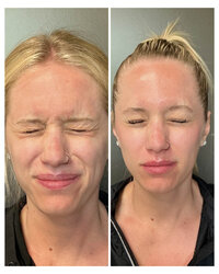 tox-injectable-before-and-after-beau-montana-2