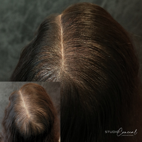 female-hair-density-treatment-in-arizona-3