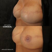 medical nipple tattoo