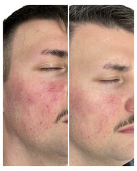 skin-and-facials-before-and-after-beau-montana-1