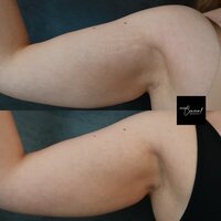 stretch-mark-arms-left-2
