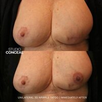 UNILATERAL AREOLA TATTOO