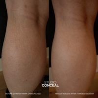inkless stretch mark camouflage