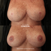 areola medical tattoo