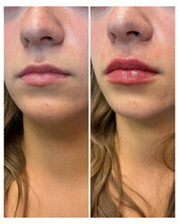 lip-filler-injectable-before-and-after-beau-montana-4