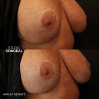 areola scar tattoo u