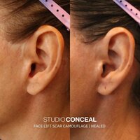 face-lift-skin-tattoo-gilbert