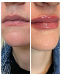 lip-filler-injectable-before-and-after-beau-montana-2