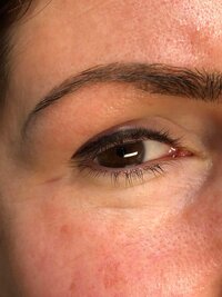 Before and after micronlading