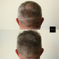 Hair-Loss-Density-Tattoo-2