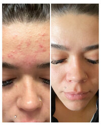 skin-and-facials-before-and-after-beau-montana-2