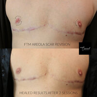 ftm scar revision areola