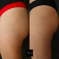 stretch-mark-rejuvenation