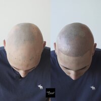 Alex-alopecia-copy