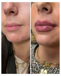 lip-filler-injectable-before-and-after-beau-montana-5