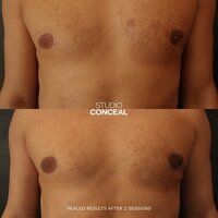 top surgery nipple tattoo