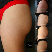 stretch-mark-cover-up-tattoo