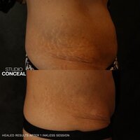 arizona stretch mark removal