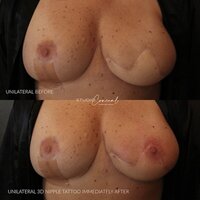 UNILATERAL-3D-AREOLA-TATTOO-