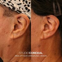 studio-conceal-face-lift-scar