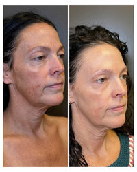 skin-and-facials-before-and-after-beau-montana-4