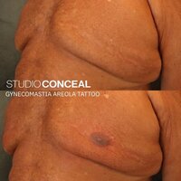 Gynecomastia AREOLA TATTOO