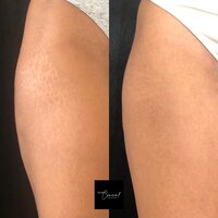 Dionne-Hip-L-2