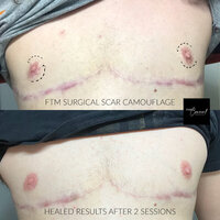 FTM SURGICAL SCAR MEDICAL TATTOO ARIZONA