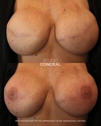 Dr. Matatov areola restoration