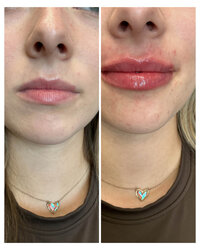 lip-filler-injectable-before-and-after-beau-montana-6