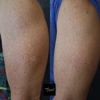 Jennifer-arm-2