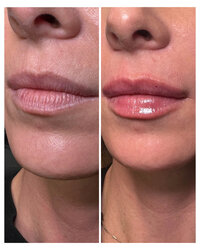 lip-filler-injectable-before-and-after-beau-montana-1