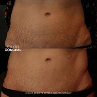 gilbert stretch mark removal