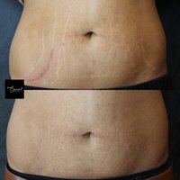 Nishant-Stomach-2-1
