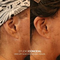 face-lift-scar-tattoo