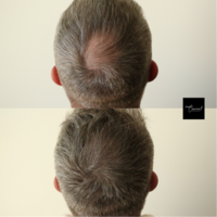 Hair-Loss-Density-Tattoo-3