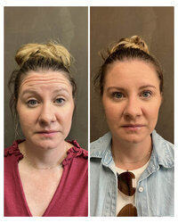 tox-injectable-before-and-after-beau-montana-1